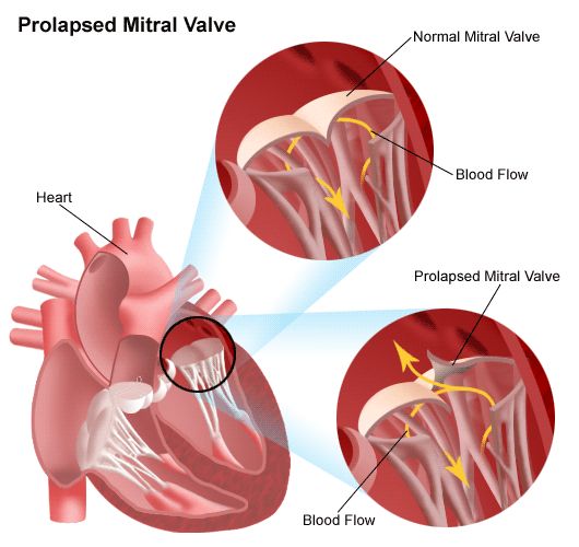 prolapsus-valve-mitrale-carabiens-le-forum